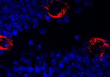 Alzheimers-2