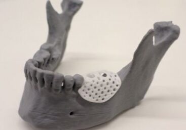 A model demonstrating where the 3D printed scaffold can be placed on a jaw.