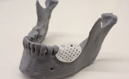 A model demonstrating where the 3D printed scaffold can be placed on a jaw.